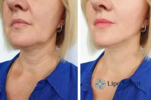 Double chin before and after Hi-Fu treatment 4 Book your double chin treatment Merthyr Tydfil today! We are here to help!