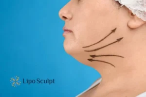 Double chin before and after Hi-Fu treatment 3 Boost your confidence with a Double chin treatment Merthyr Tydfil