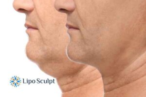 Double chin before and after Hi-Fu treatment 2 Double chin treatment Merthyr Tydfil from Lipo Sculpt - feel more confident today!