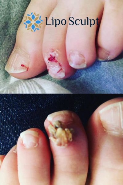 Wart removal customer results from Lipo Sculpt Merthyr Tydfil