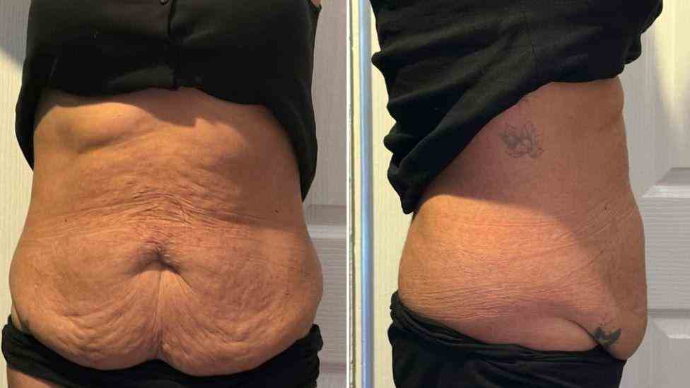 Lost the Weight but Not the Loose Skin? What You Should Know 1 Is It Definitely Loose Skin Merthyr Tydfil?